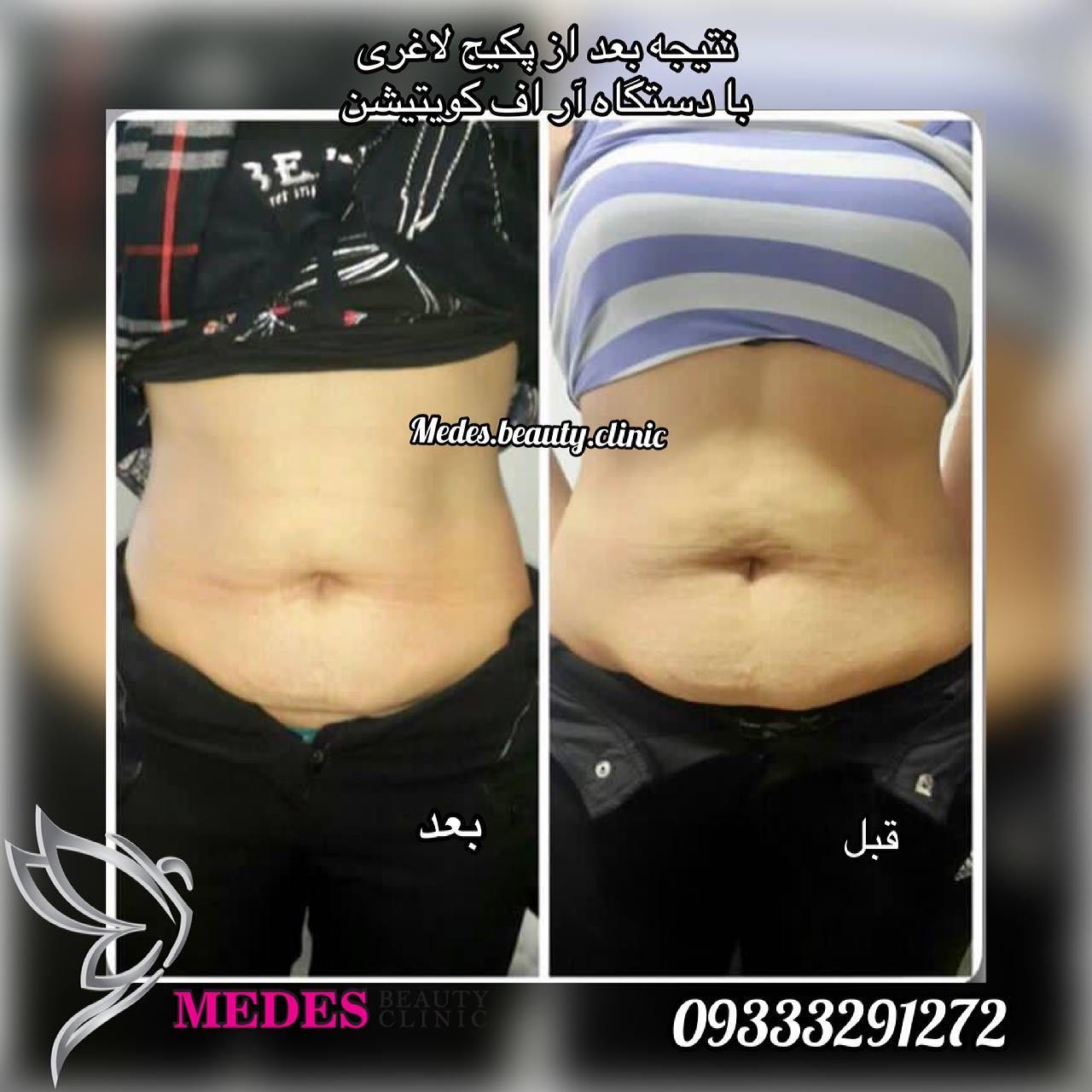 گالری لاغری با دستگاه